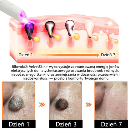 ✨ Bikenda®  – Laserowy Długopis CO₂ do Usuwania 🟤 Znamion, 🦠 Brodawek, 🔘 Przebarwień i Innych Niedoskonałości Skóry
