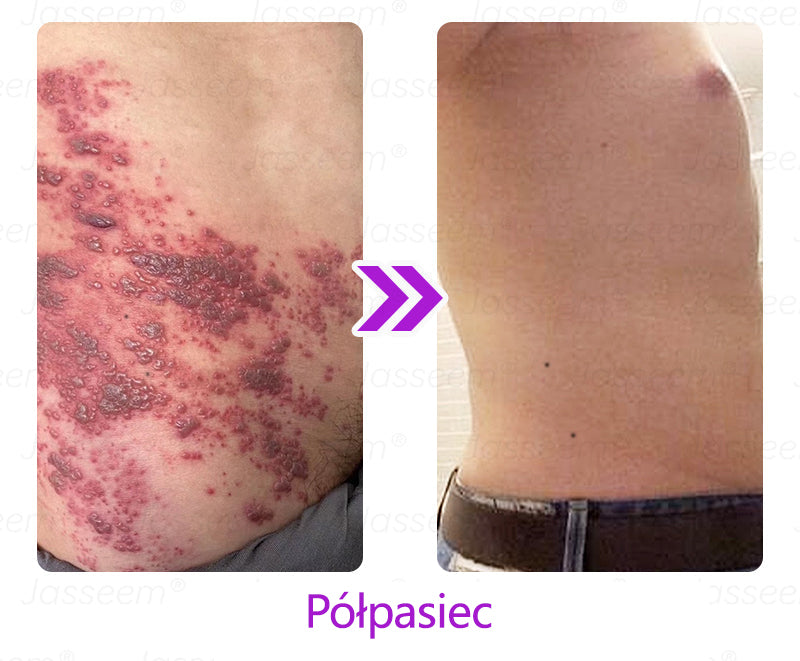 𝐉𝐚𝐬𝐬𝐞𝐞𝐦® Zaawansowany nieinwazyjny laser CO₂ do naprawy skóry 🎉 (Delikatnie usuwa brodawki, znamiona, plamy starcze i narośla skórne – bez bólu, bez zamieszania!)