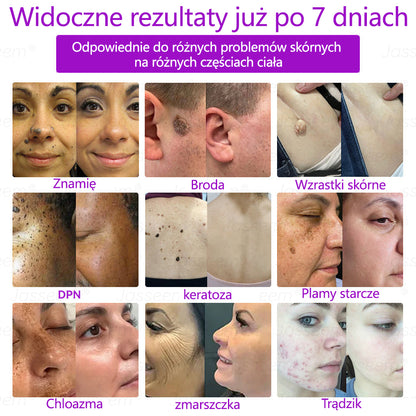 𝐉𝐚𝐬𝐬𝐞𝐞𝐦® Zaawansowany nieinwazyjny laser CO₂ do naprawy skóry 🎉 (Delikatnie usuwa brodawki, znamiona, plamy starcze i narośla skórne – bez bólu, bez zamieszania!)