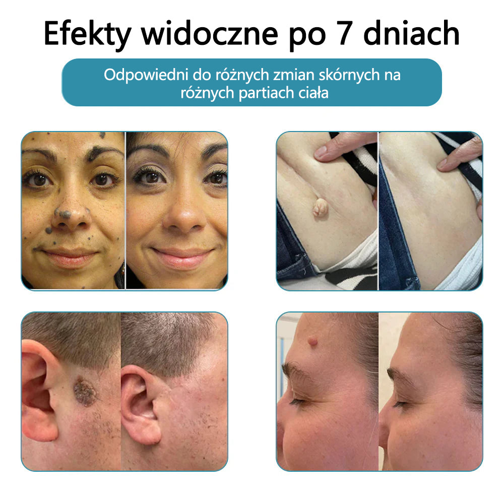 ✨ Bikenda®  – Laserowy Długopis CO₂ do Usuwania 🟤 Znamion, 🦠 Brodawek, 🔘 Przebarwień i Innych Niedoskonałości Skóry