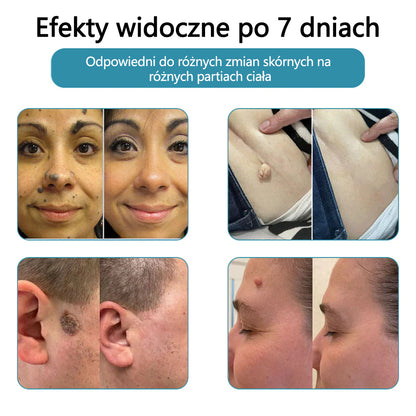 ✨ Bikenda®  – Laserowy Długopis CO₂ do Usuwania 🟤 Znamion, 🦠 Brodawek, 🔘 Przebarwień i Innych Niedoskonałości Skóry
