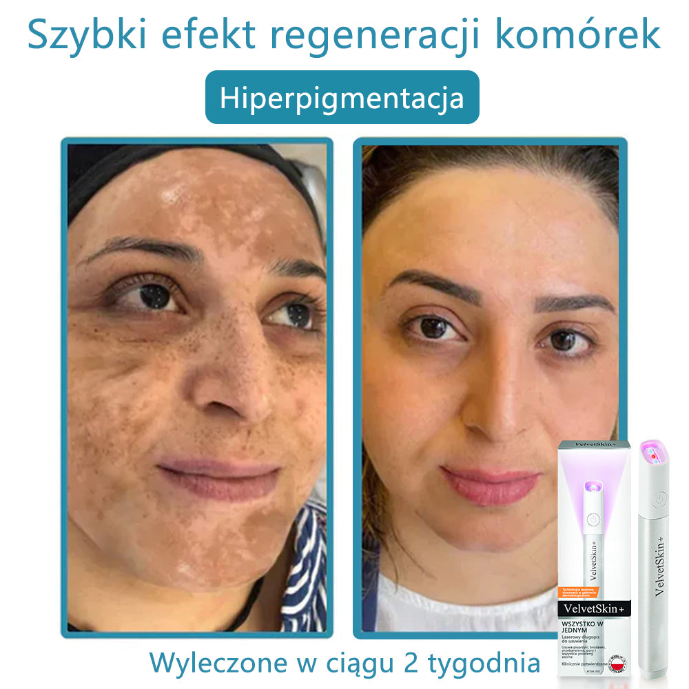 ✨ Bikenda®  – Laserowy Długopis CO₂ do Usuwania 🟤 Znamion, 🦠 Brodawek, 🔘 Przebarwień i Innych Niedoskonałości Skóry