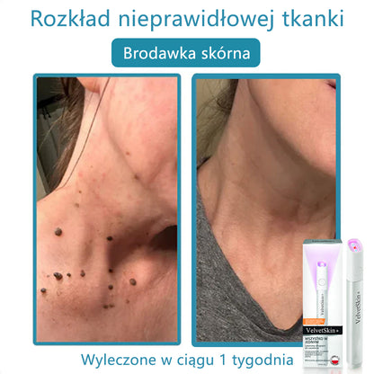 ✨ Bikenda®  – Laserowy Długopis CO₂ do Usuwania 🟤 Znamion, 🦠 Brodawek, 🔘 Przebarwień i Innych Niedoskonałości Skóry