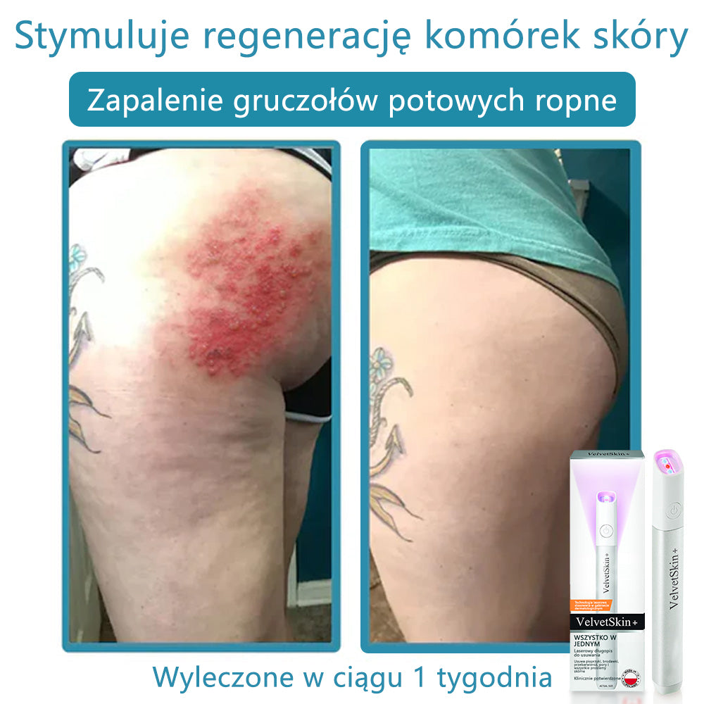 ✨ Bikenda®  – Laserowy Długopis CO₂ do Usuwania 🟤 Znamion, 🦠 Brodawek, 🔘 Przebarwień i Innych Niedoskonałości Skóry